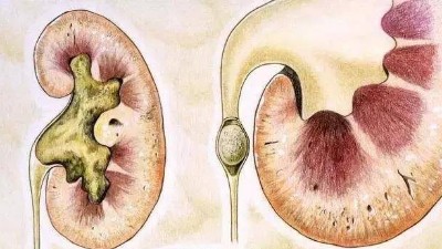 腎結(jié)石是怎么引起的？