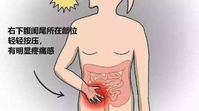 慢性闌尾炎需要切除嗎？