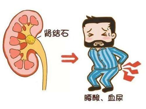 得了腎結(jié)石怎么辦？